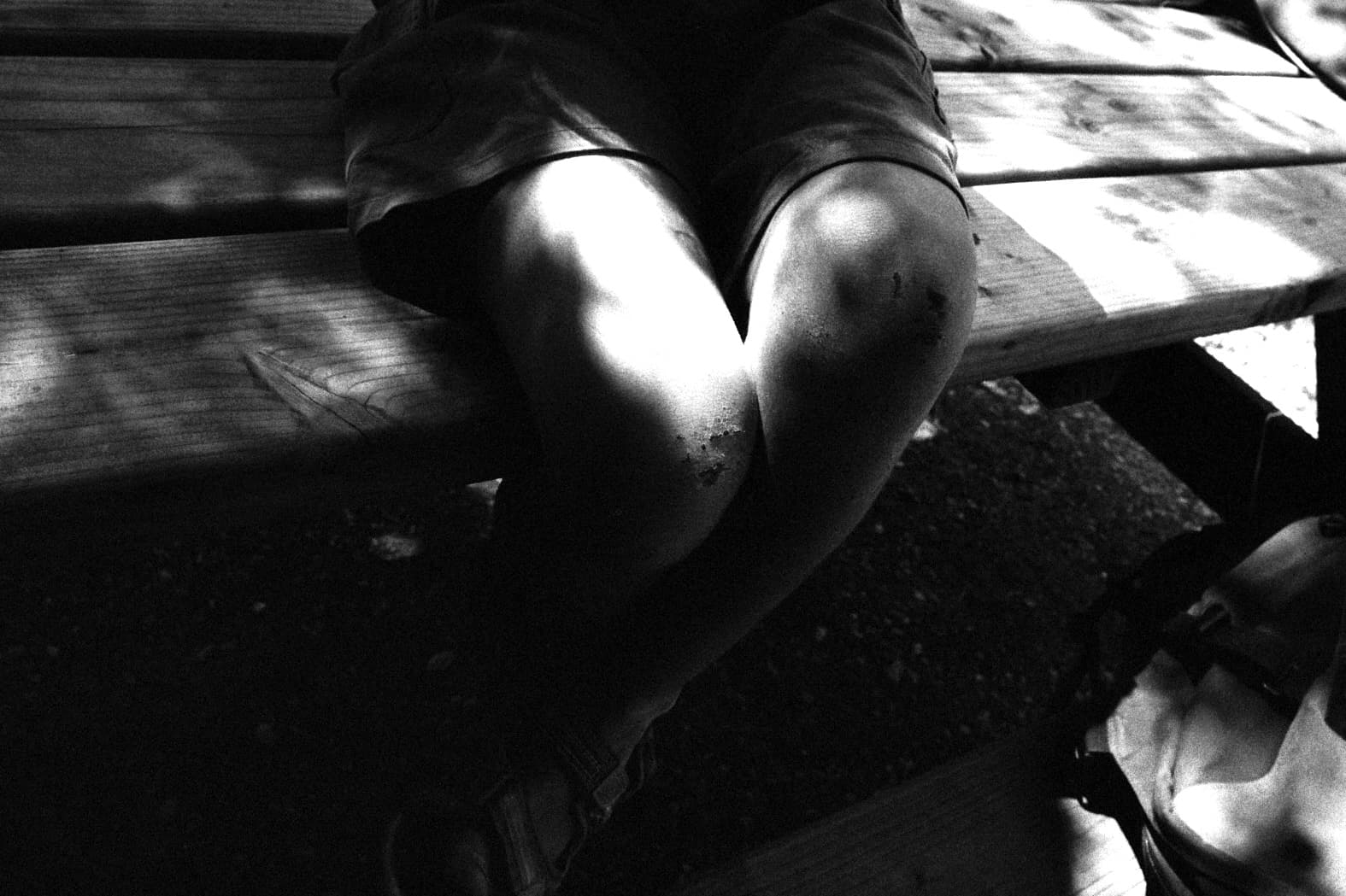 Close-up of a child's knees with scars on the skin